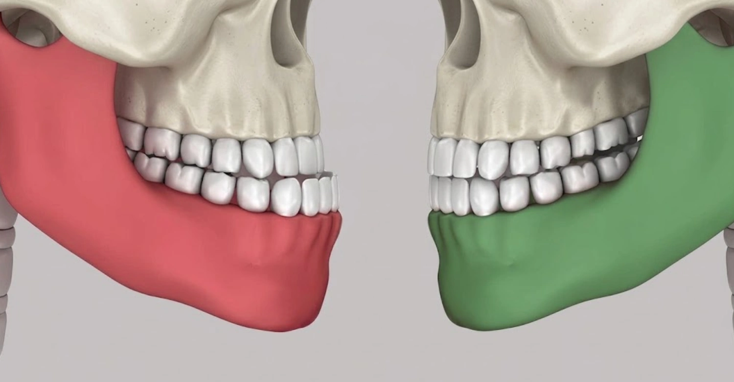 Underbite Correction Inblog